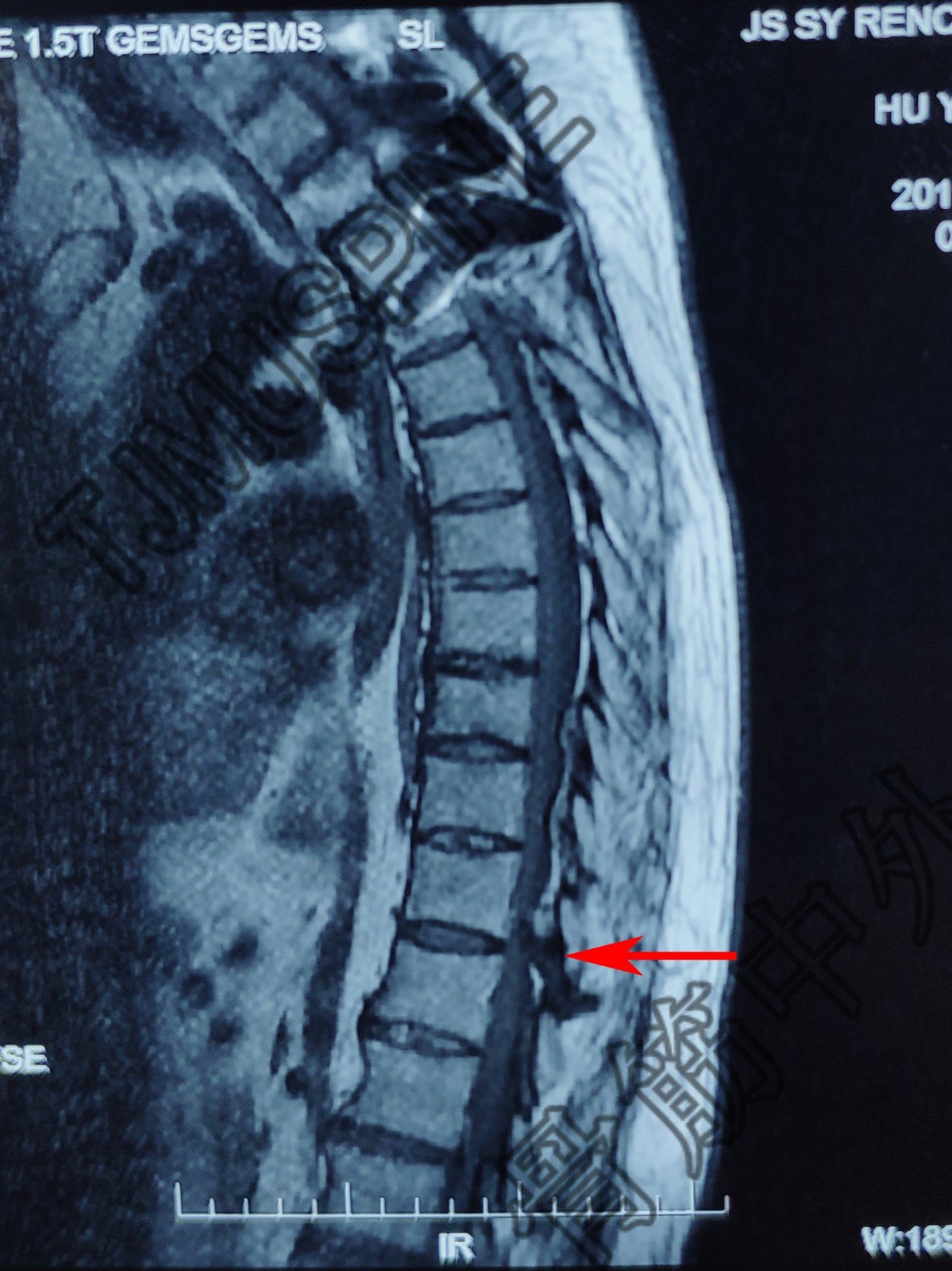 箭頭所示t11/12壓迫嚴重t8-l2多發黃韌帶骨化,向前壓迫脊髓及硬膜囊術