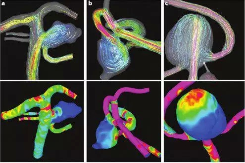 這些圖片則展示了顱內動脈瘤的形態,動脈瘤和其載瘤動脈內血流的方向
