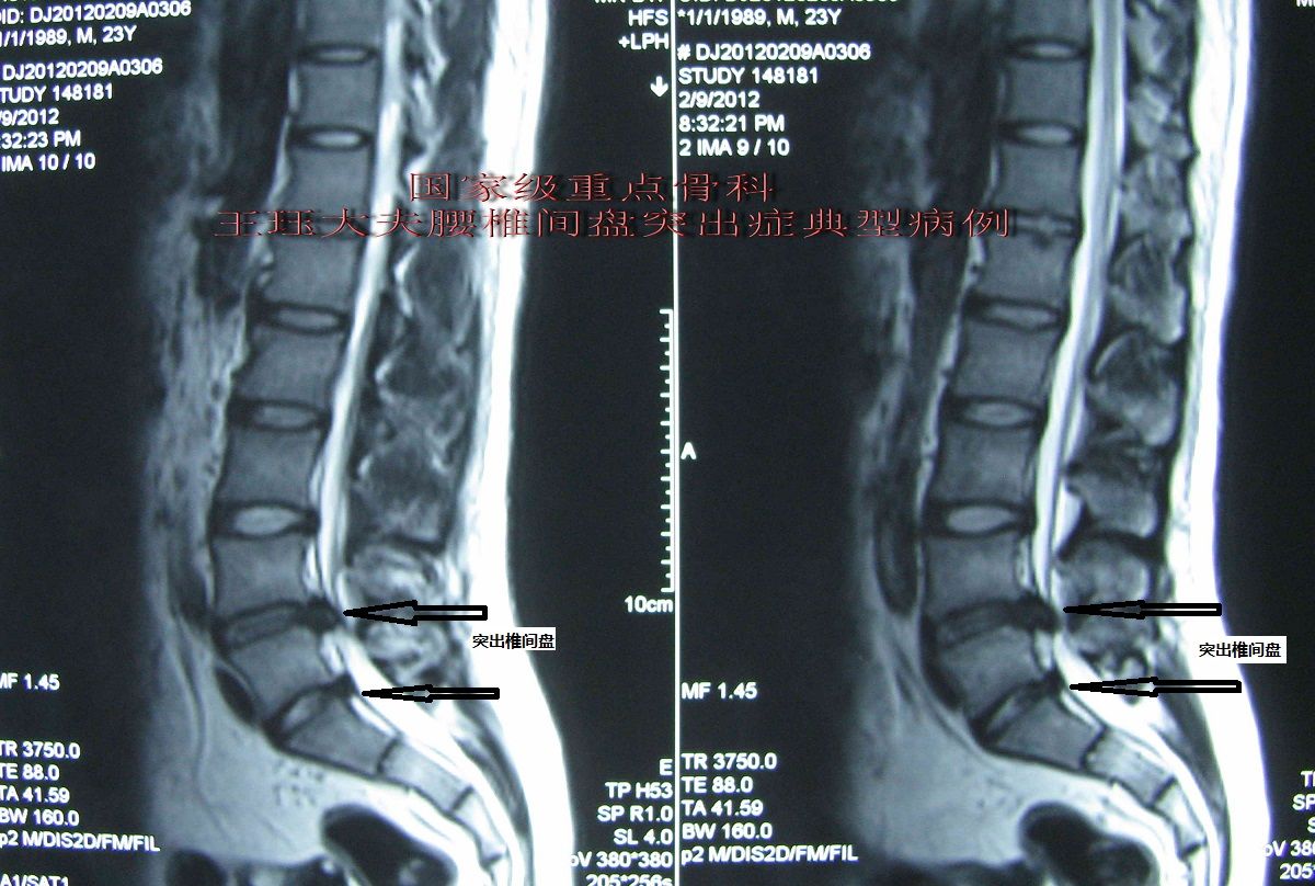 病例17男24歲青年腰椎間盤突出症常見類型椎體後緣離斷症