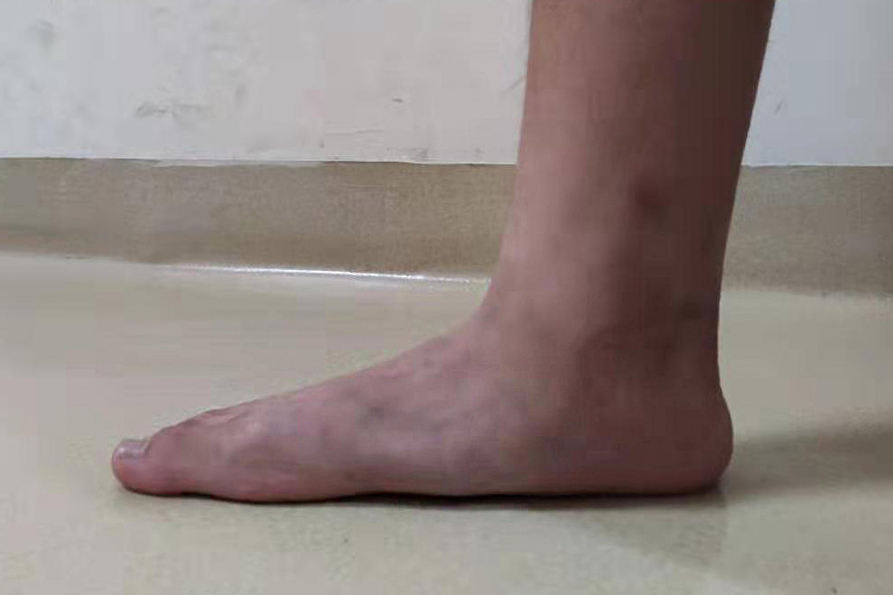 扁平足应该穿什么鞋(扁平足应该穿什么鞋子) 第1张 扁平足应该穿什么鞋(扁平足应该穿什么鞋子) 第1张