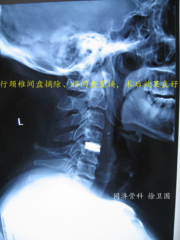 脊柱外科典型病例頸椎病之三頸椎間盤置換