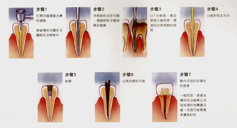 兒牙專欄乳牙根管治療的重要性